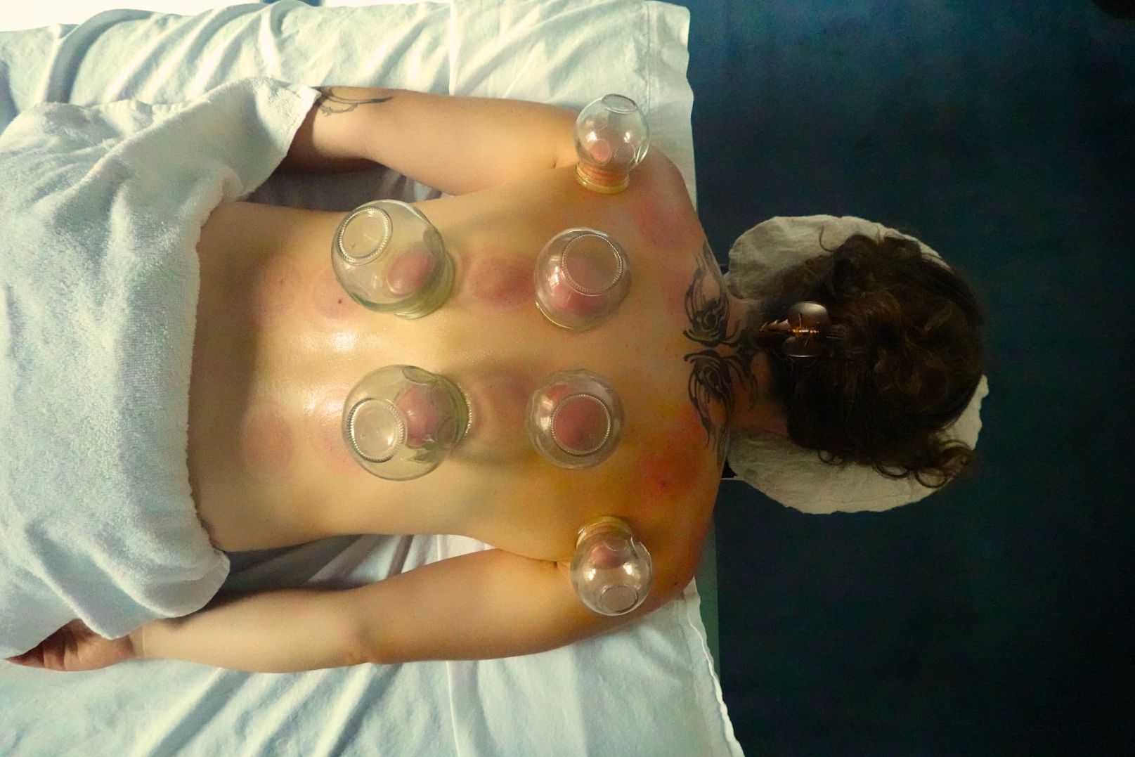 cupping on back